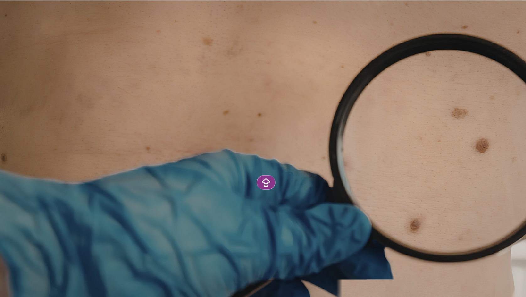 CIENTÍFICOS DE LA UNAM INVESTIGAN EL DESARROLLO DEL CÁNCER DE PIEL MÁS COMÚN EN MÉXICO